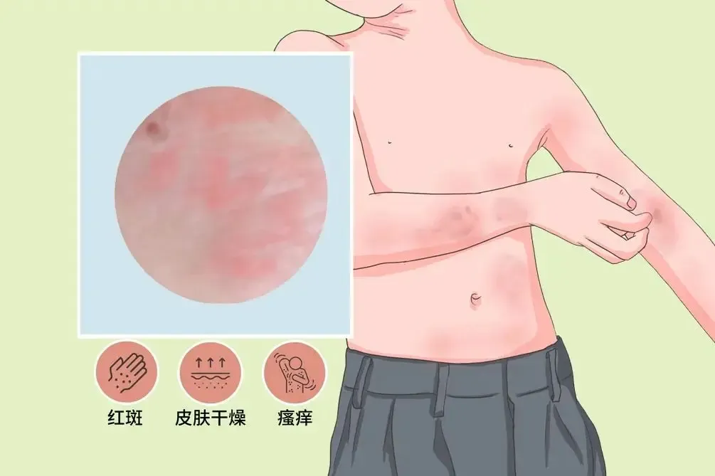 有关特应性皮炎 I 新型JAK1抑制剂国内二期临床研究@陆前进教授 I 中国医学科学院皮肤病医院及全国26家参研医院